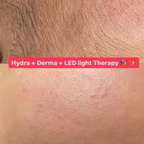 Korean Hydra Facial + Nano Infusion at Michelle's Skin Studio